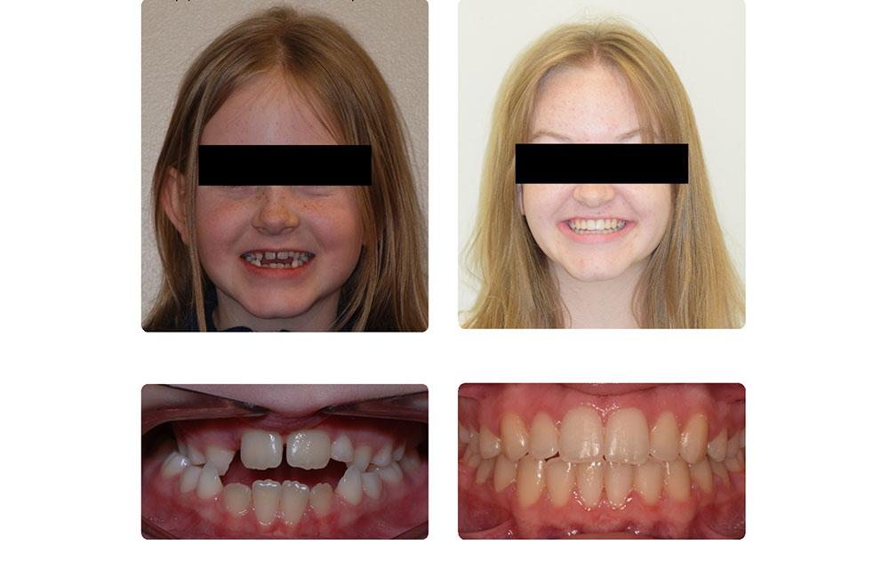 overbite before and after